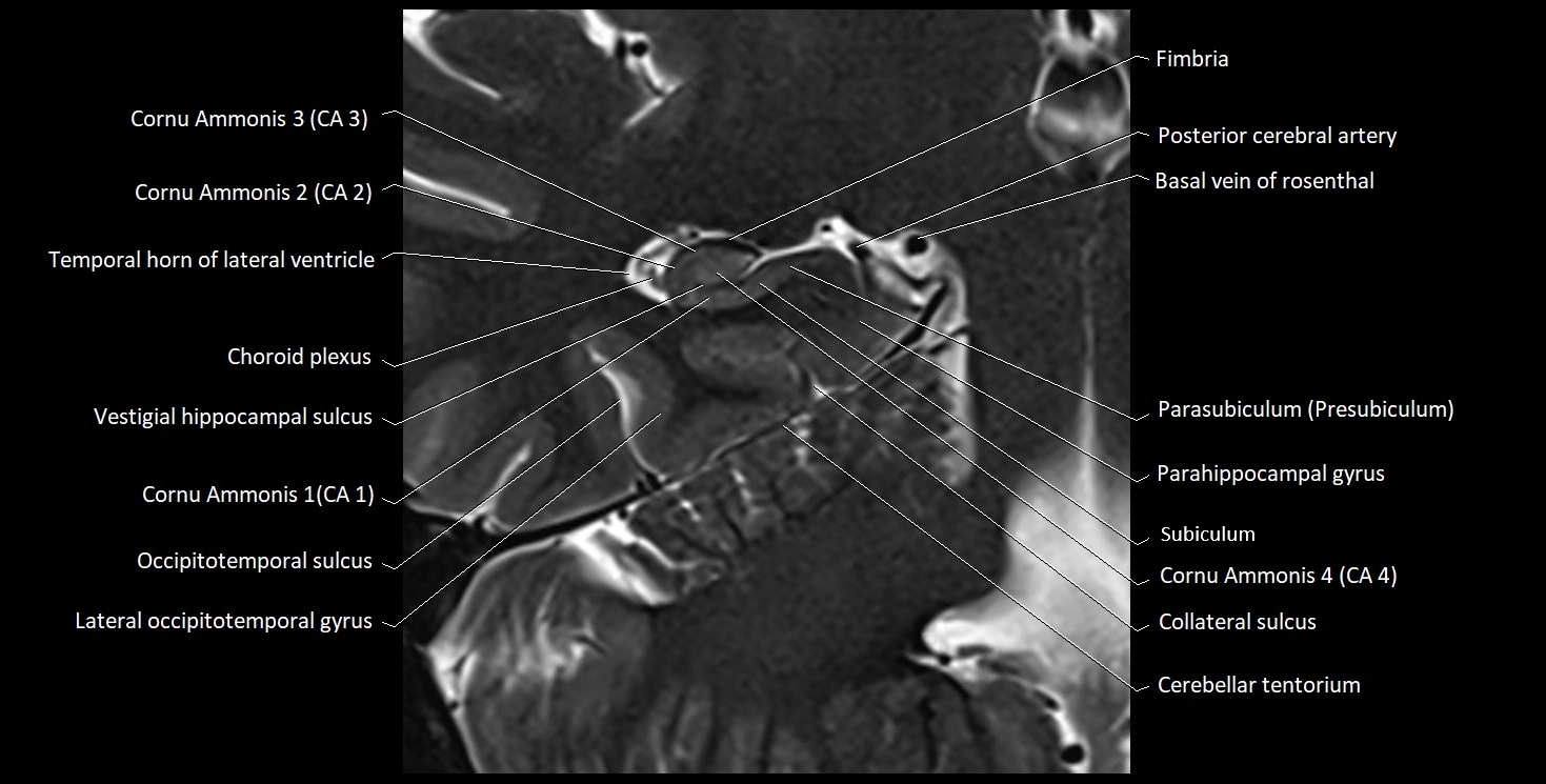 Hippocampus anatomy mri coronal cross section 3T MRI image 12.webp